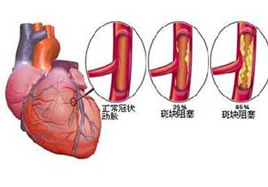 為什么冠心病在冬季高發?預防冠心病的方法補硒