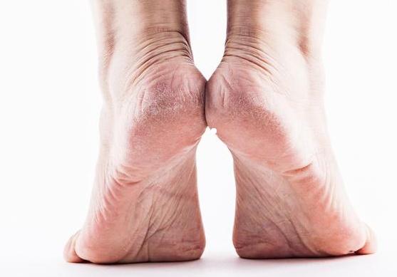 腳后跟經常起皮開裂，是缺乏維生素嗎